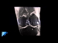 How to Read Knee MRI of Normal Knee | Anatomy of the Knee | Complex Knee Surgeon | Minneapolis , MN