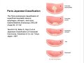 Approach to the Difficult Polypectomy