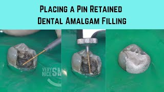 Placing a pin retained Dental amalgam filling screenshot 2