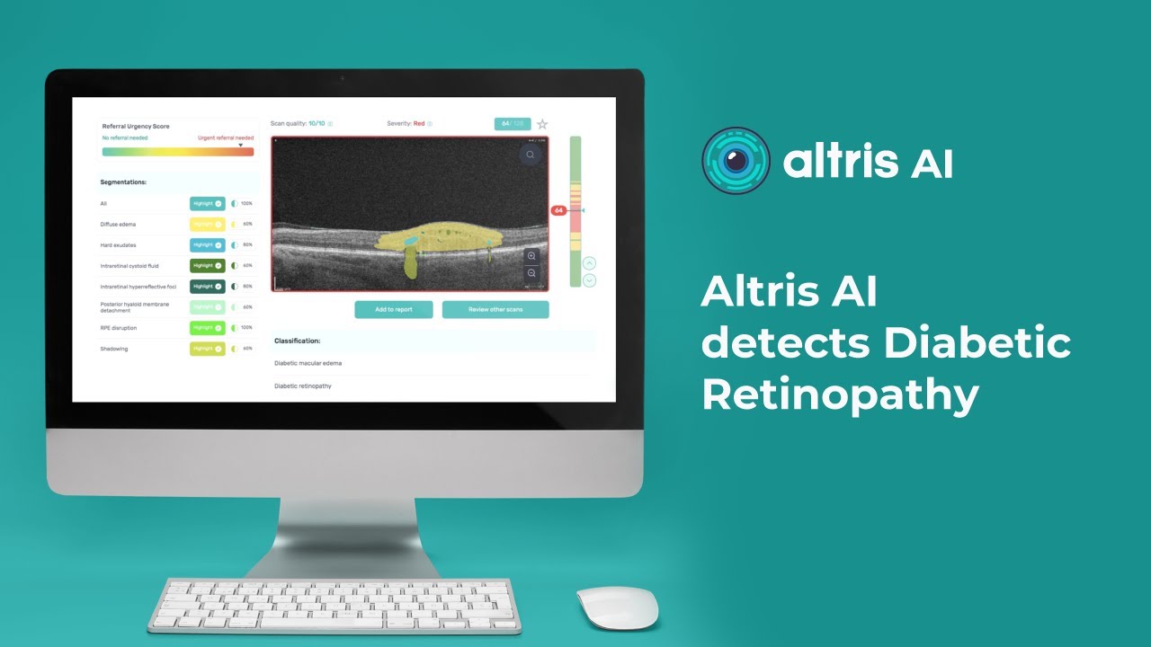 AI For Diabetic Retinopathy Detection On OCT YouTube AI For Diabetic Retinopathy Detection On OCT YouTube