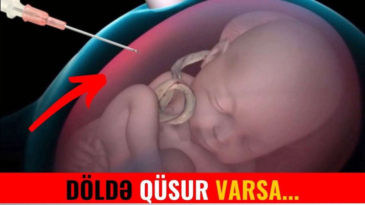 Hamiləlik Zamanı Döldə Qüsur Aşkar Edildikdə Ana Bətnində Müalicə Etmək Mümkündürmü?