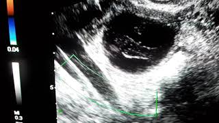 Ultrasound Diagnosis of Complex Ovarian Cyst Complex Adnexal Cyst Ultrasound Case 27