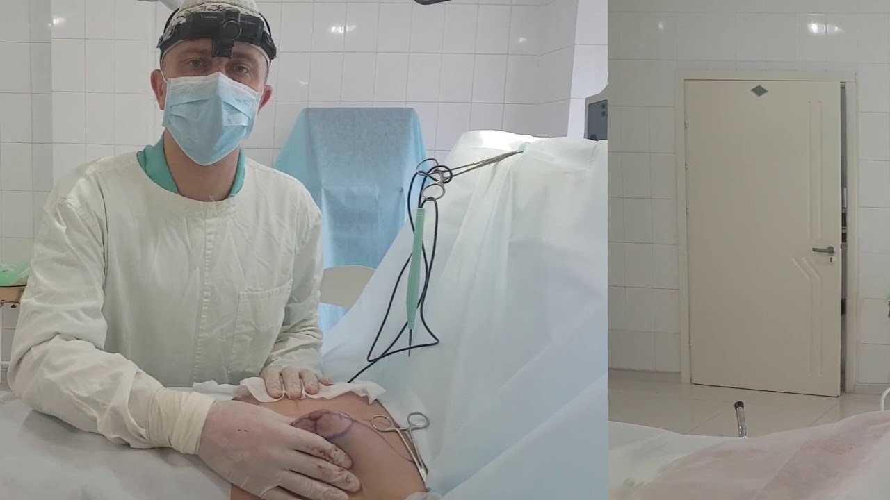 Двухсторонняя подкожная мастэктомия в Одессе - YouTube