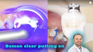 Damon clear self ligating braces placing on, step by step bonding Damon ceramic braces, full details