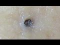 【No.4】Big keratin plug's!巨大角栓達!