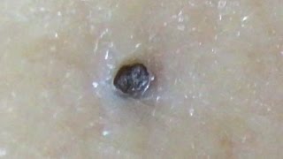 【No.4】Big keratin plug's!巨大角栓達!