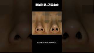 보형물 없는 매부리코수술 + 귀족수술