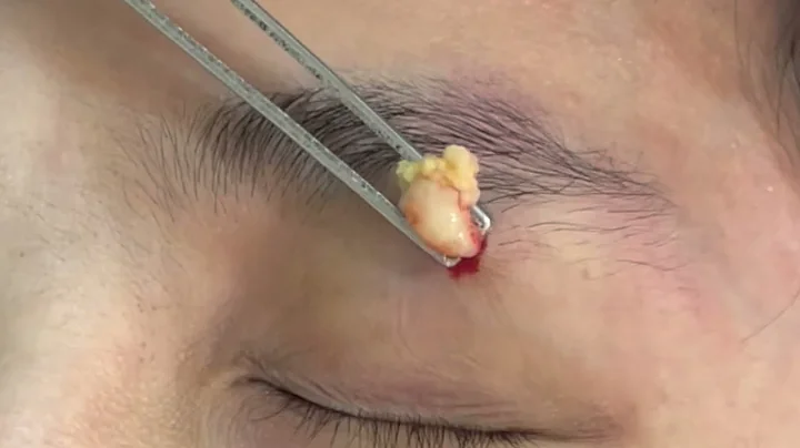 眼皮粉瘤切除 美麗新城診所莊禮謙醫師 Epidermal Cyst Excision, Dr George - 天天要聞
