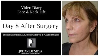 Facelift & Neck Lift Video Diary Day 8 After Surgery