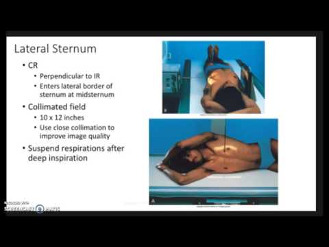 Video: Sternum Popping: Behandling, Smerter, Brystsmerter Og Symptomer