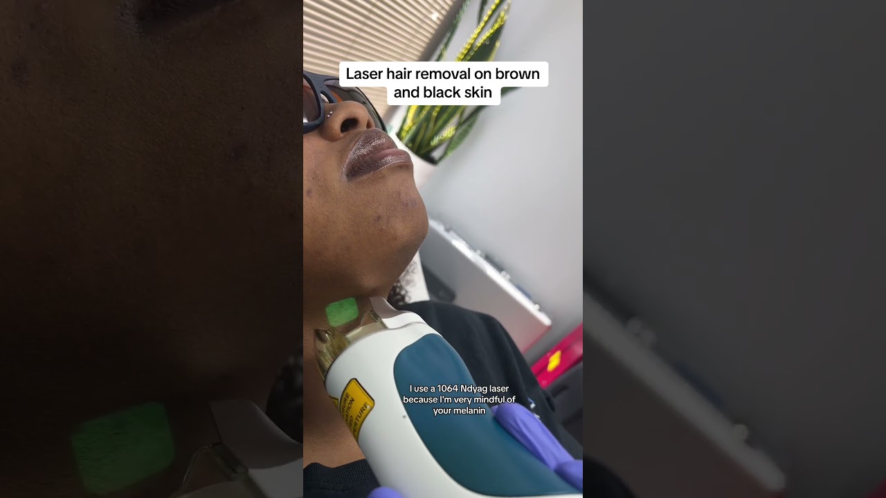 Лазерная эпиляция на смуглой коже!