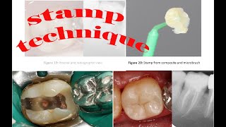 Occlusal stamp technique #micro_brush_stamp_technique