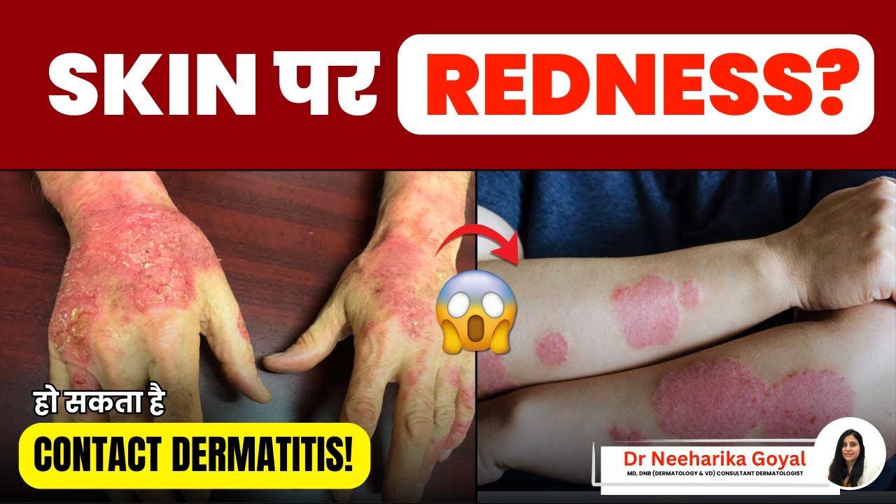 What is Contact Dermatitis In Hindi? | Explained By Dr. Neeharika 