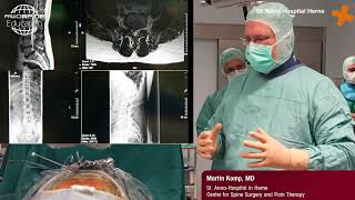 Full-endoscopic spine surgery interlaminar approach performed by Dr. M. Komp