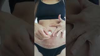 31 Days Tummy Tuck Scar And Belly On