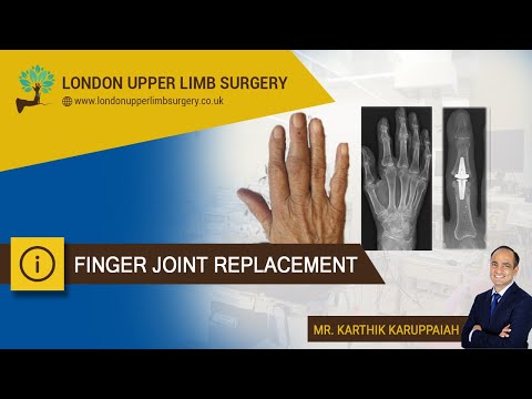 Finger joint replacement