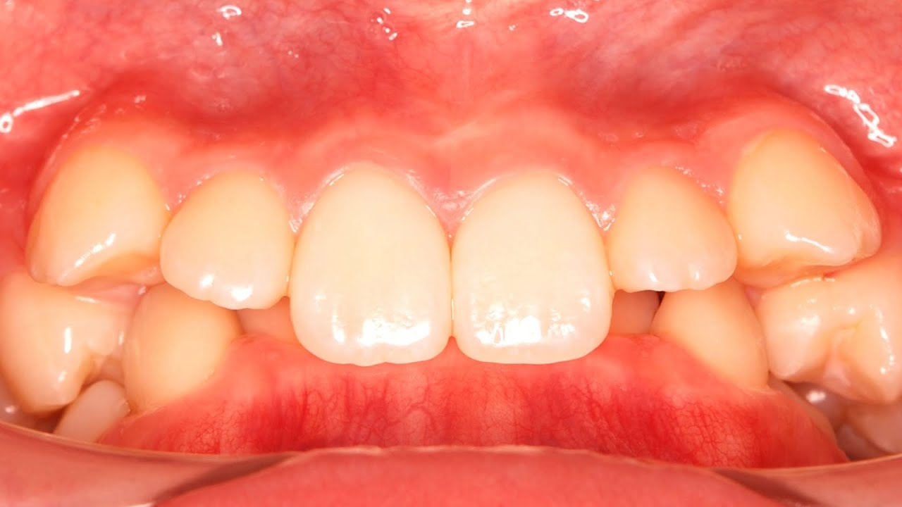 Overbite: The upper front teeth are crushed and the lower front teeth are completely hidden