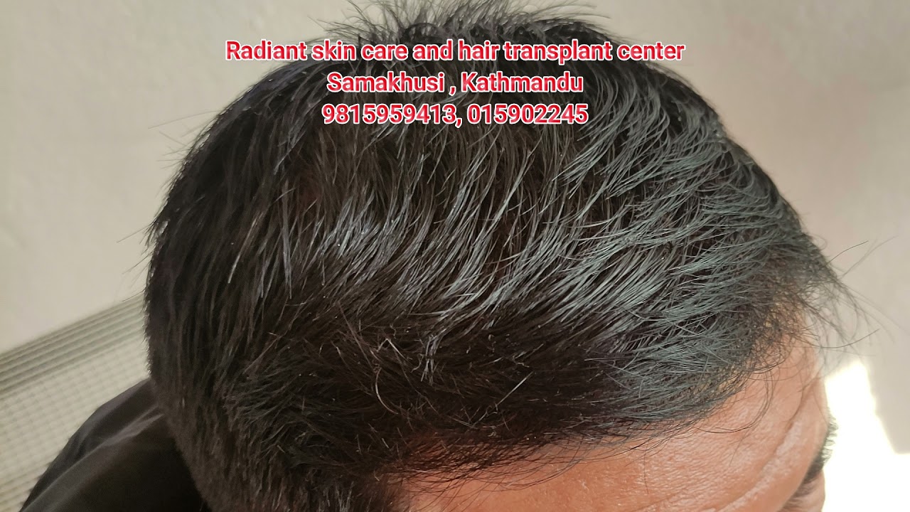 Hair transplant result in Nepal at 5 months YouTube