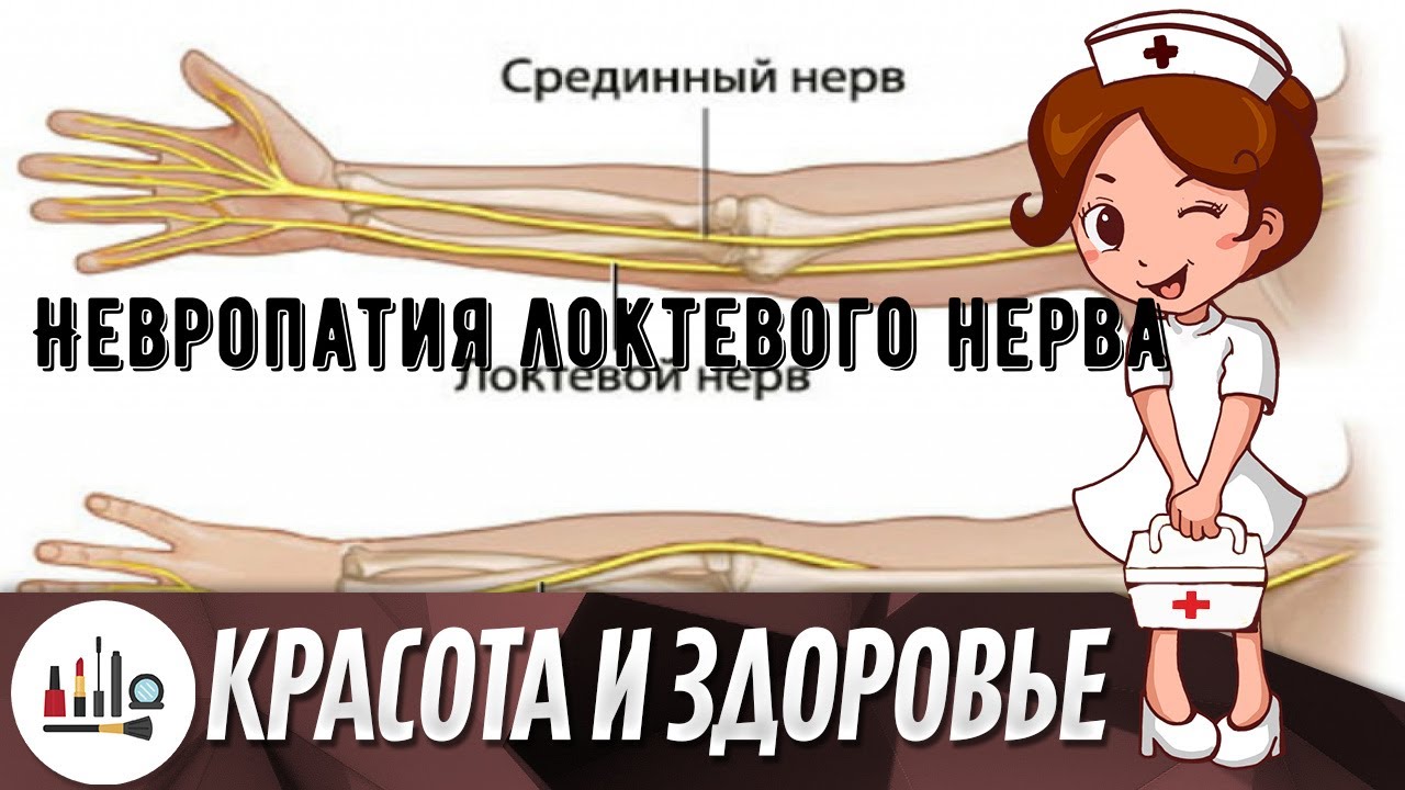 Невропатия локтевого нерва