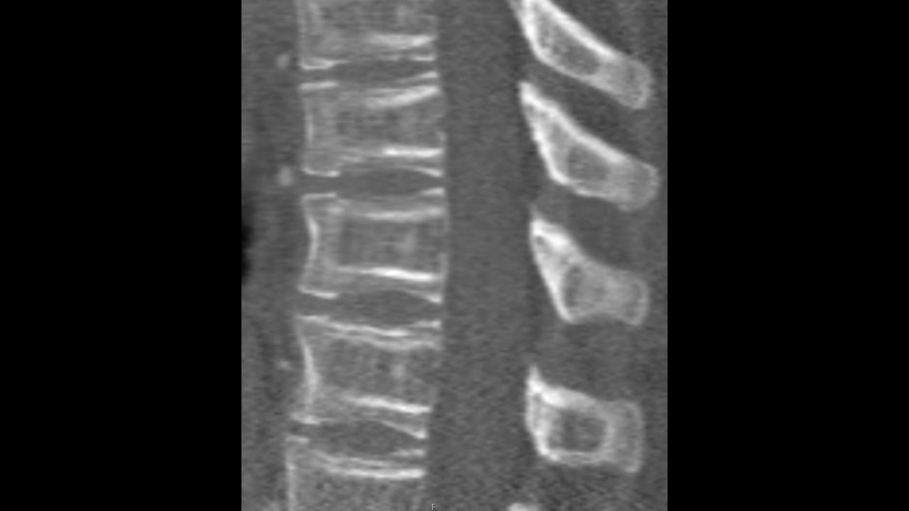 BONE within a BONE sign in a 26 year old male - YouTube