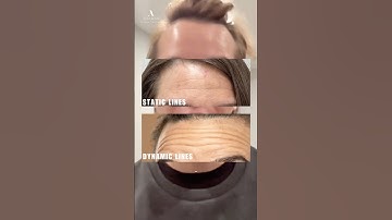 Static lines vs. Dynamic lines #shorts #wrinkles