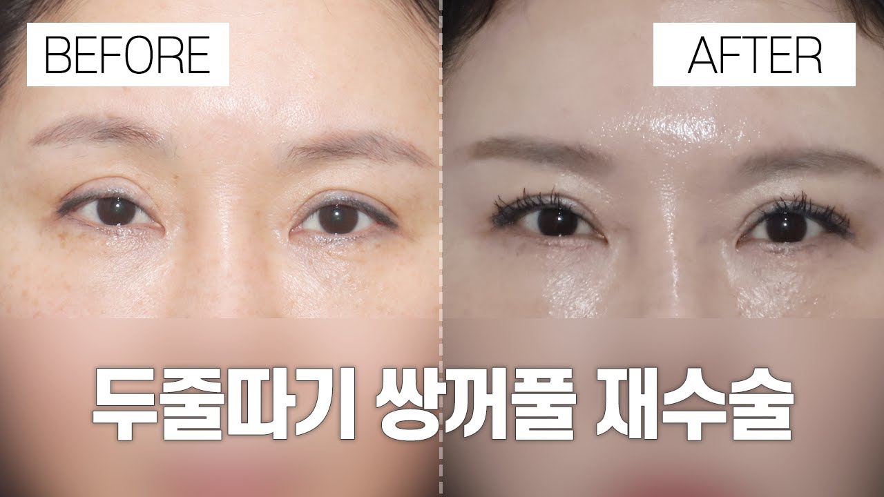 [Ганнам Соён гоо сайхны мэс заслын эмнэлэг] | Нүдний гоо сайхны мэс засал өмнө ба дараа | Тэгш бус, хүнд хэлбэрийн нүдэнд тодорхой давхар зовхи хийх | Тэгш бус нүдийг