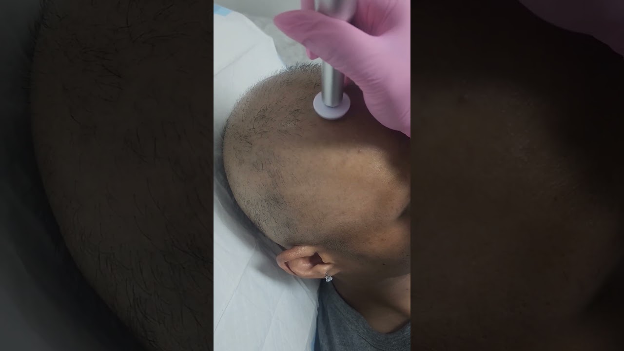 Procell Microchanneling for Alopecia Totalis at Nurse Nyma Aesthetics in Brisbane.