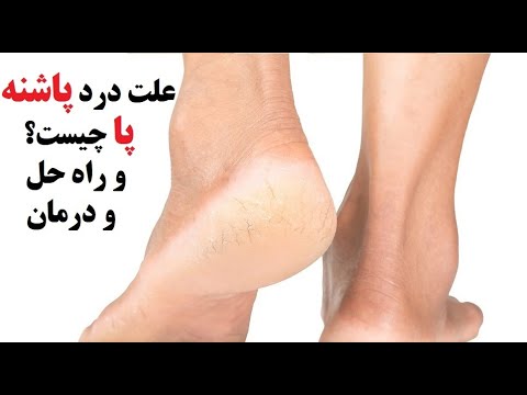 تصویری: اگر کفشی پاهای شما را مالش داد چه باید کرد