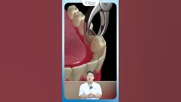 Nhổ Răng Không Đau | Nha Khoa Minh Châu
