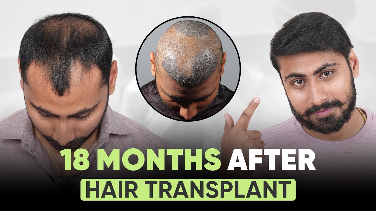 Hair Transplant in Gurgaon (HX-FOOY) | Best Results & Cost of Hair Transplant in Gurgaon.
