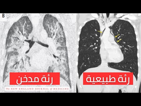 ماذا تسبب السجائر الإلكترونية أو الفيب للرئة