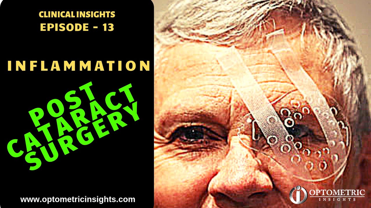Inflammation Post Cataract Surgery Episode 13 YouTube