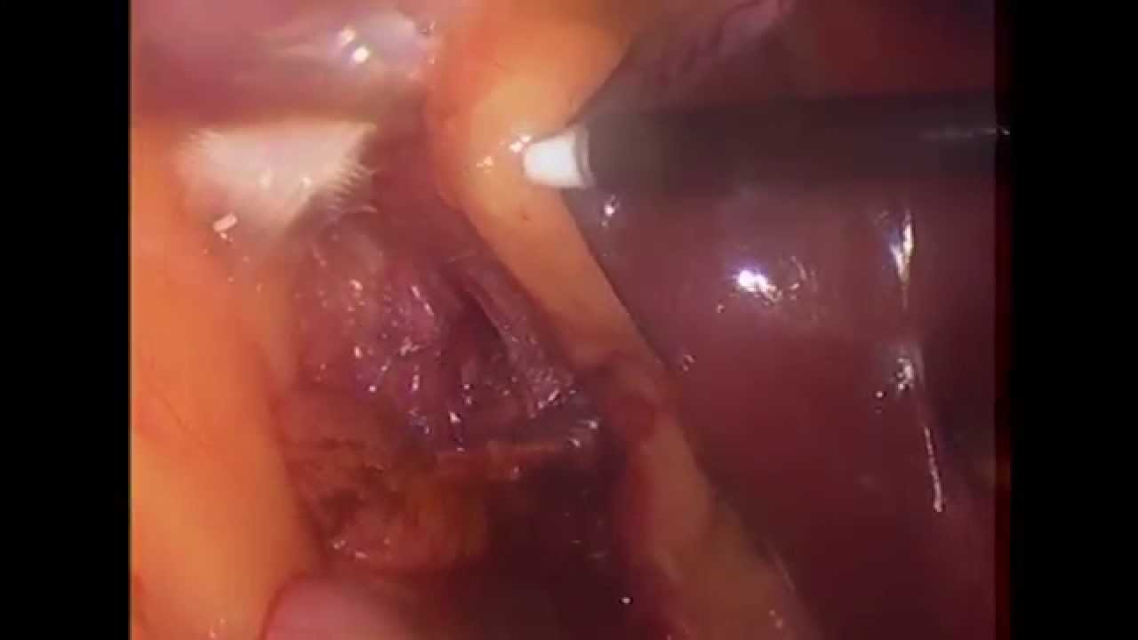 Aderências na vesícula biliar / Adhesions in the gallbladder doutor estranho filme