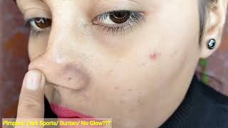 How To Remove Pimples Overnight | Acne Treatment | Priya Creations screenshot 4