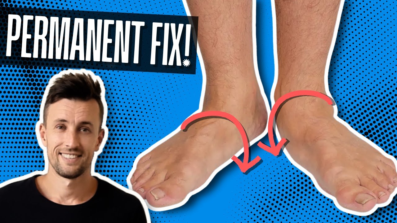 Как НАВСЕГДА исправить плоскостопие