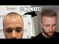 HAARTRANSPLANTATION ISTANBUL - Update nach 5 MONATEN - Vorher Nachher