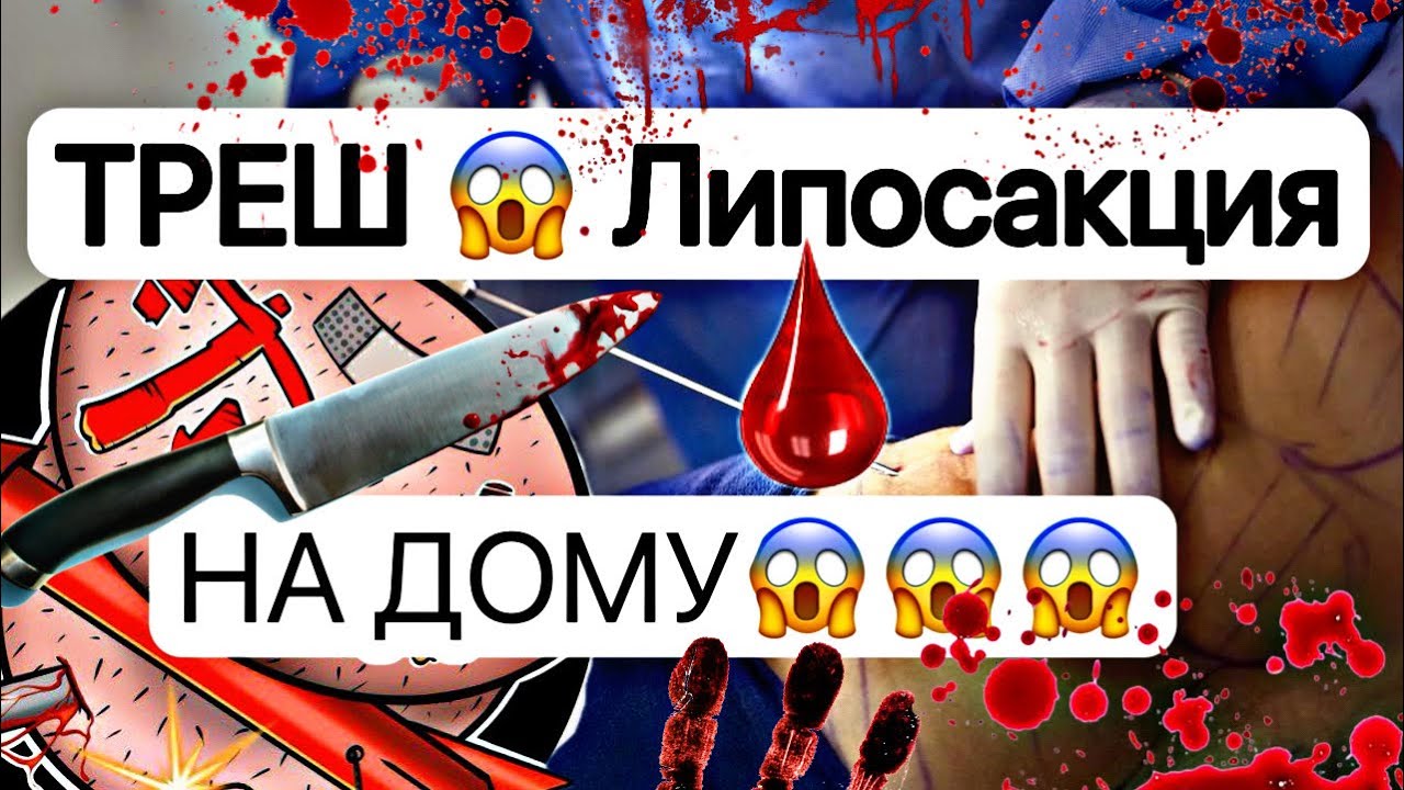 ТРЕШ ЛИПОСАКЦИЯ НА ДОМУ.ПЛАСТИЧЕСКИЕ ОПЕРАЦИИ НА ДОМУ💥ФИЛЛЕРЫ С ВАЛДБЕРИЗ😱😱😱