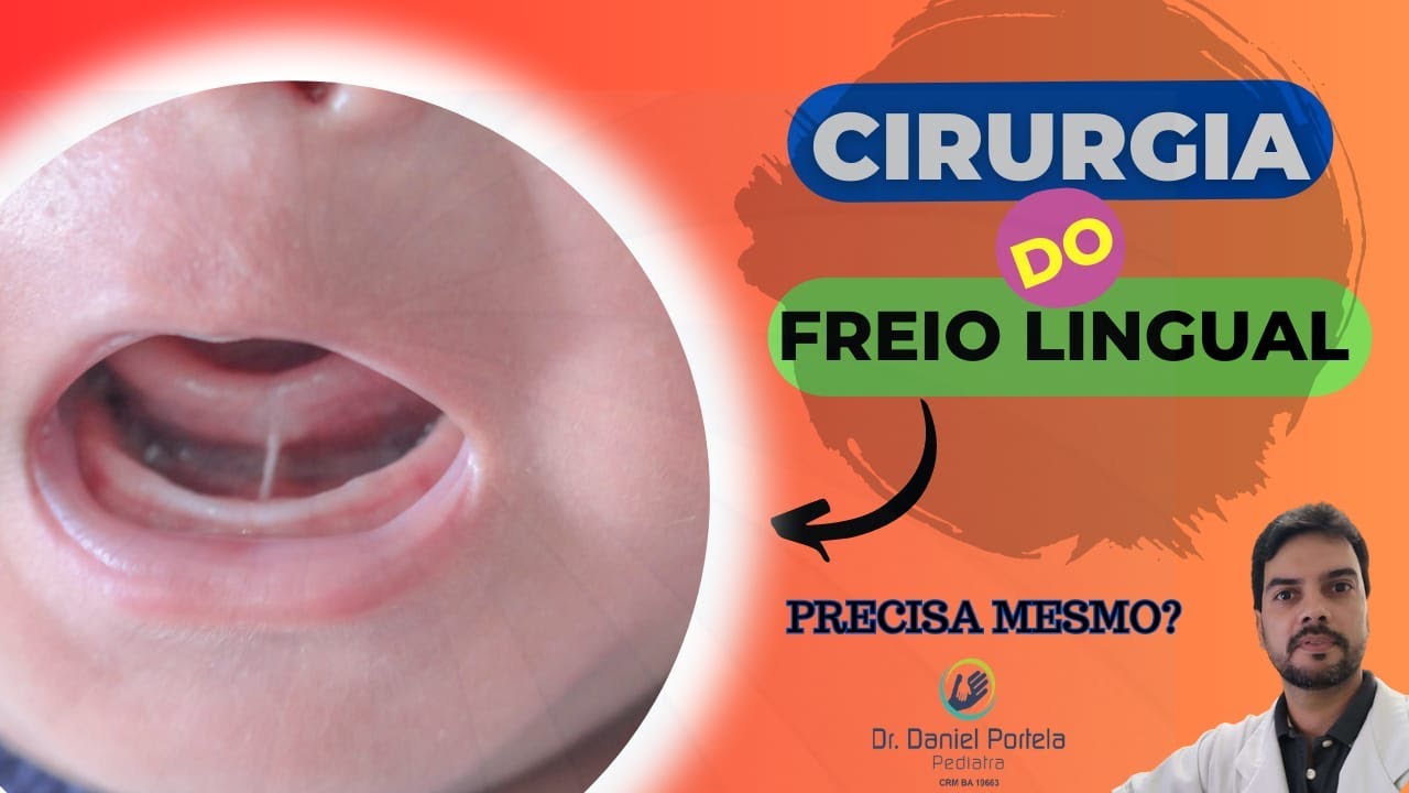 CIRURGIA DO FREIO LINGUAL: precisa mesmo? - YouTube