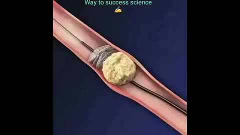 Awesome procedure ureteroscopic kidneys stone removal - DayDayNews