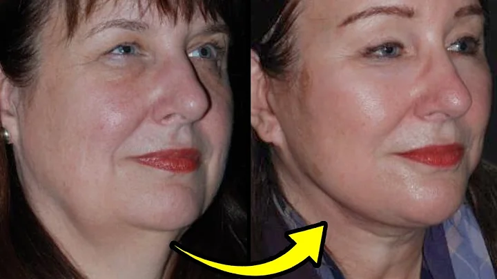 What is a DEEP PLANE NECK LIFT? Plastic Surgeon Answers