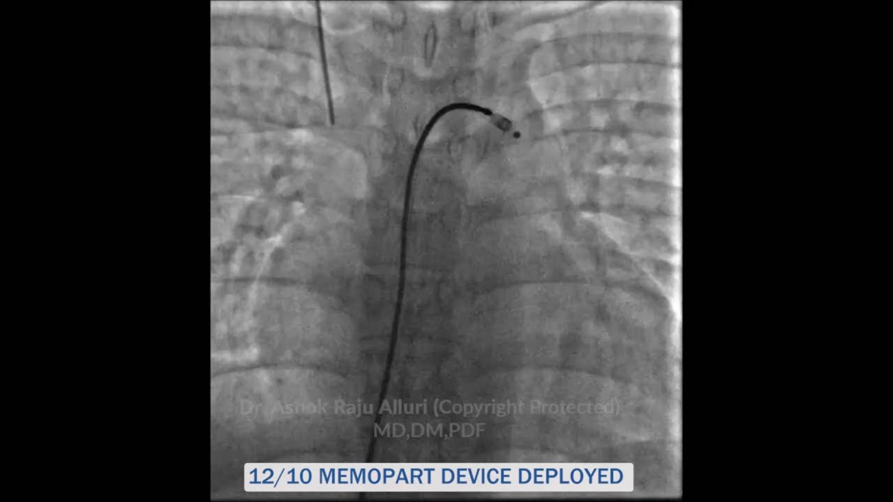 RSOV DEVICE CLOSURE l Dr. Alluri Ashok Raju l Ashok Cardiac Care l Cardiologist l Visakhapatnam