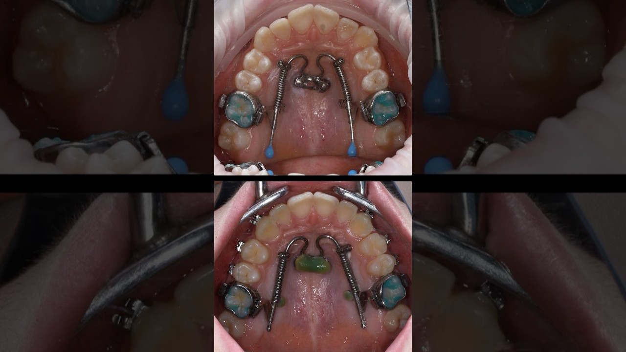 Работа на Дистализаторе 