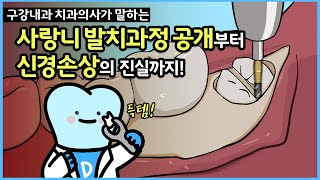 사랑니 발치 영상과 사랑니 부작용의 모든 것. (feat.안면마비, 신경마비, 안면통증, 매복 사랑니 신경손상과 설신경)