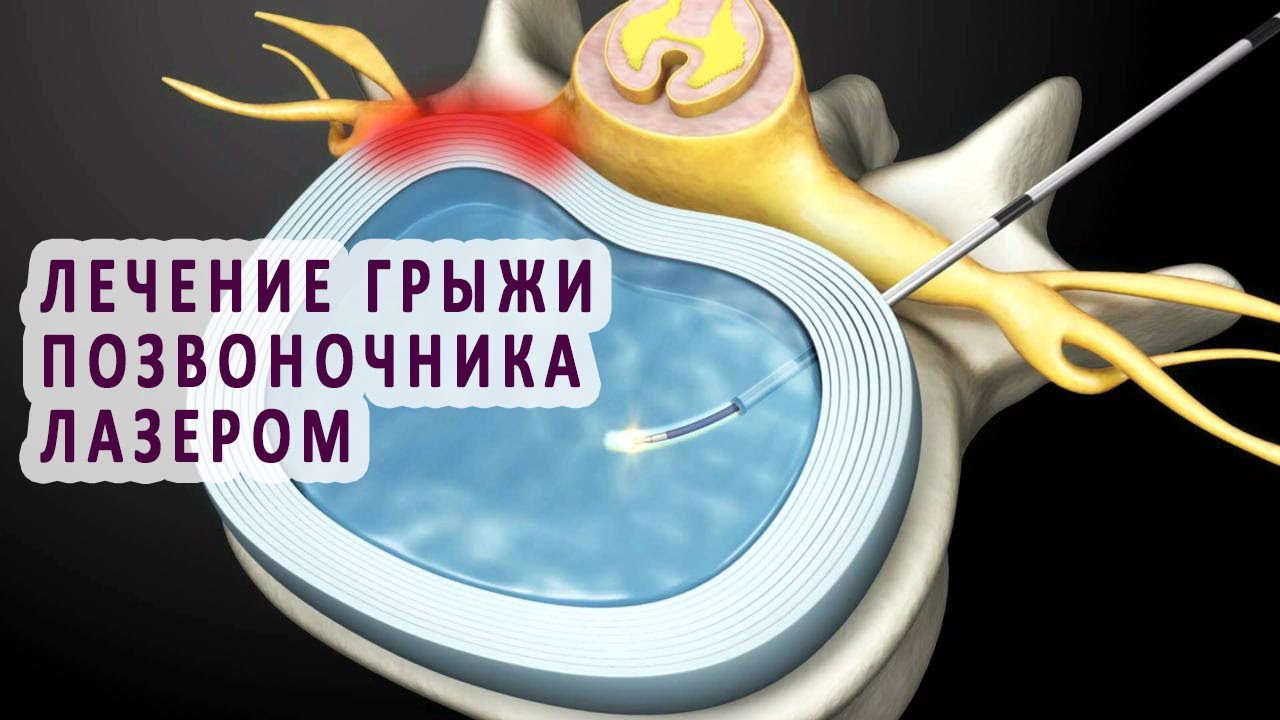 Лазером удаляют грыжу. Лазерная терапия грыжи позвоночника. Лазерная операция на грыжу позвоночника. Операция лазером на позвоночнике грыжа. Лазерная вапоризация грыжи межпозвоночного диска.