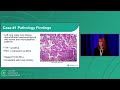 Who’s Driving Treatment? Two Co-Occurring Driver Mutations in Primary Lung Adenocarcinoma