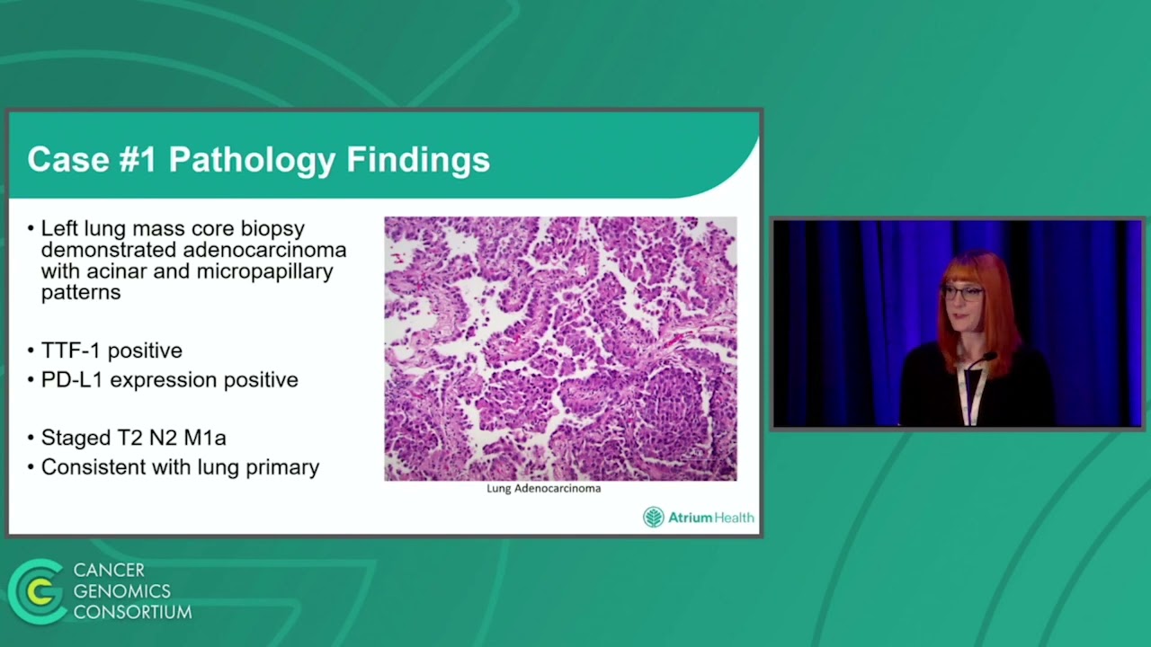 Who’s Driving Treatment? Two Co-Occurring Driver Mutations in Primary Lung Adenocarcinoma