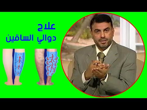 علاج دوالي الساقين في المنزل بوصفات طبيعية