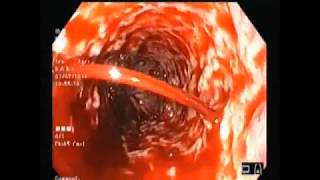 esophageal varices band ligation(EVL)