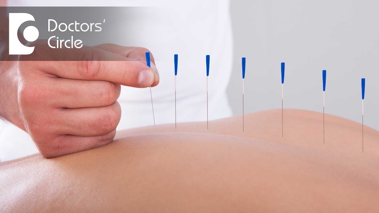 Dry Needling in Physical Therapy