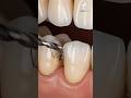 Cracked to Rotten 😱 | Broken Tooth Decay Repair &amp; Full Restoration | #ai #satisfying #cavityremoval